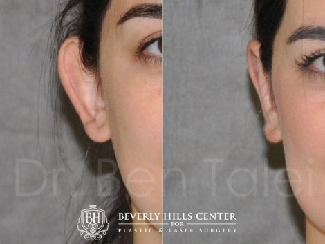 Beverly Hills Center Female Patient Before and After Otoplasty Procedure
