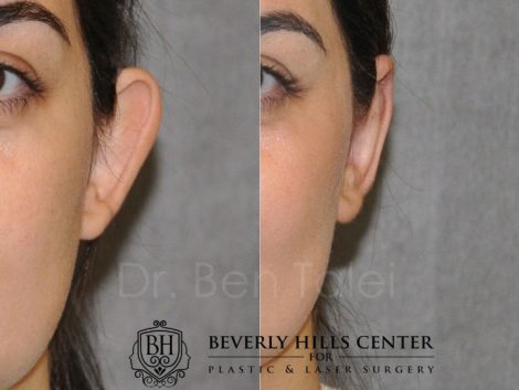 Beverly Hills Center Female Patient Before and After Otoplasty Procedure