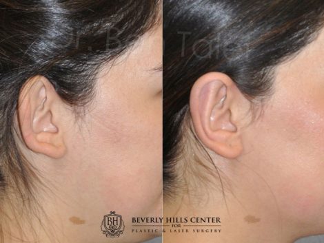 Beverly Hills Center Female Patient Before and After Otoplasty Procedure