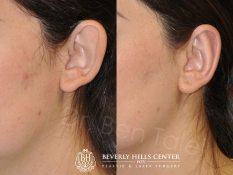 Beverly Hills Center Female Patient Before and After Otoplasty Procedure