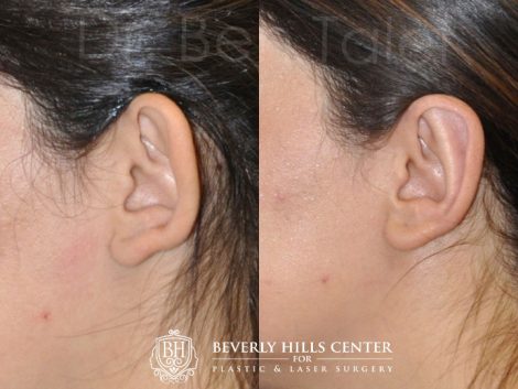 Beverly Hills Center Female Patient Before and After Otoplasty Procedure