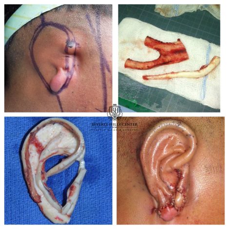 Beverly Hills Patient During and After Repair of Microtia Procedure
