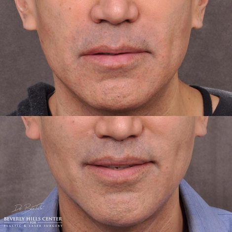 Modified upper lip lift and Profound - Front
