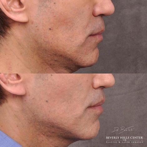 Modified upper lip lift and Profound - Right Side