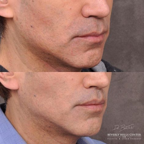 Modified upper lip lift and Profound - Right Side