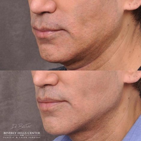 Modified upper lip lift and Profound - Left Side