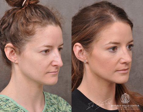 Rhinoplasty & Modified Upper Lip Lift - Right Side