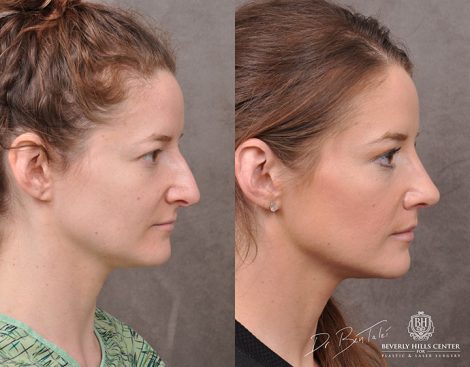 Rhinoplasty & Modified Upper Lip Lift - Right Side