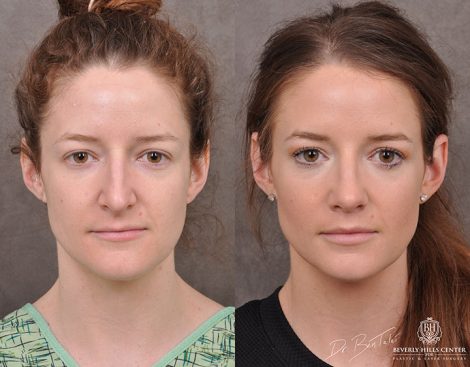 Rhinoplasty & Modified Upper Lip Lift - Front