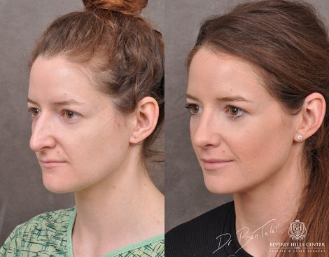Rhinoplasty & Modified Upper Lip Lift - Left Side