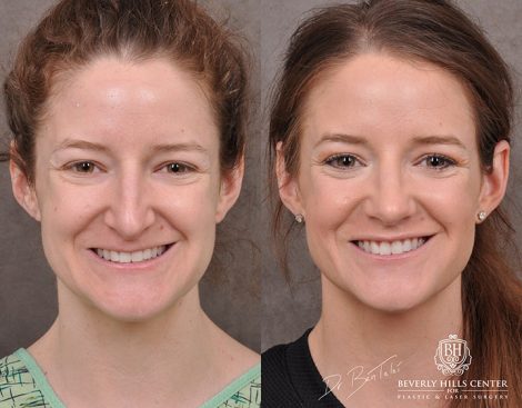 Rhinoplasty & Modified Upper Lip Lift - Front