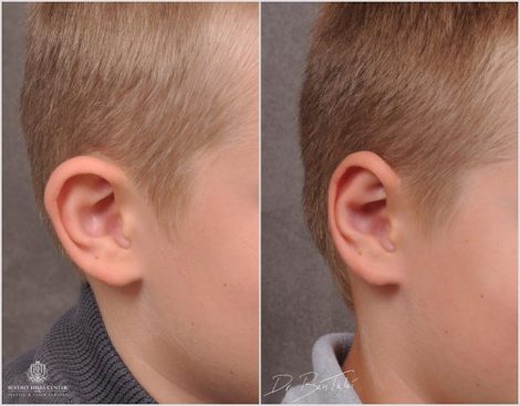 Beverly Hills Young Boy Patient Before and After Otoplasty Procedure