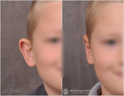 Beverly Hills Young Boy Patient Before and After Otoplasty Procedure