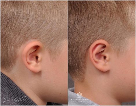 Beverly Hills Young Boy Patient Before and After Otoplasty Procedure