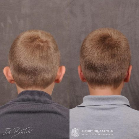 Beverly Hills Young Boy Patient Before and After Otoplasty Procedure