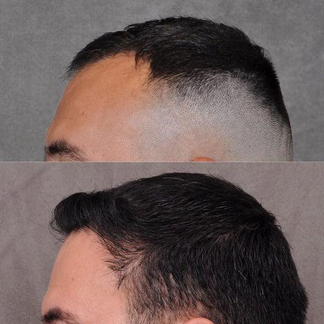 Beverly Hills Center Male Patient Before and After FUE hair transportation and PRP treatment