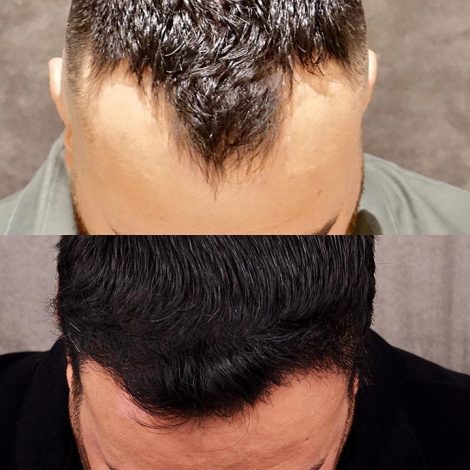 Beverly Hills Center Male Patient Before and After FUE hair transportation and PRP treatment