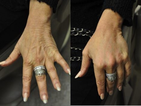 Beverly Hills Center Female Patient Before and After Hand Rejuvenation Procedure