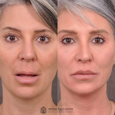 Modified Upper Lip Lift - Front