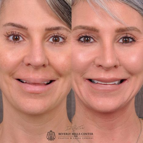 Modified Upper Lip Lift - Front