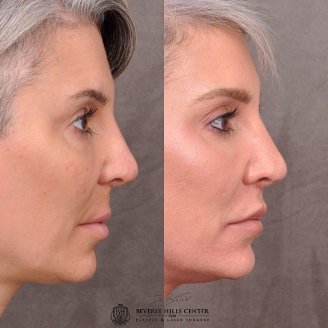 Modified Upper Lip Lift - Right Side