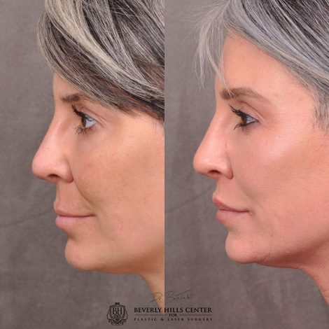 Modified Upper Lip Lift - Left Side