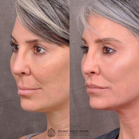 Modified Upper Lip Lift - Left Side
