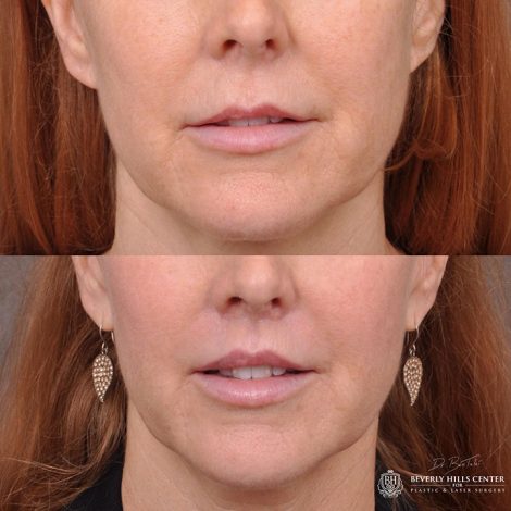 Modified upper lip lift - Front