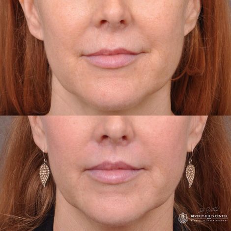 Modified upper lip lift - Front