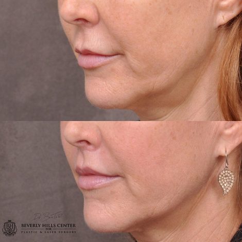 Modified upper lip lift - Left