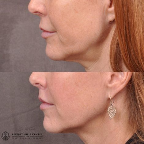 Modified upper lip lift - Left