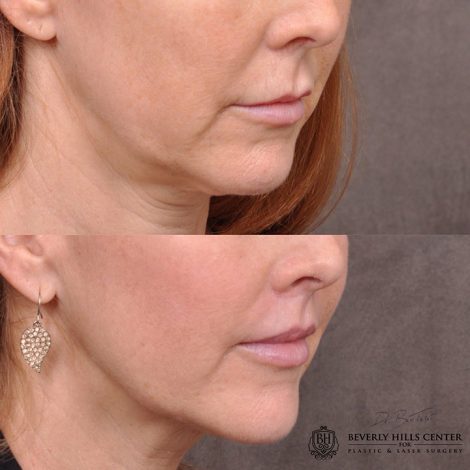 Modified upper lip lift - Right
