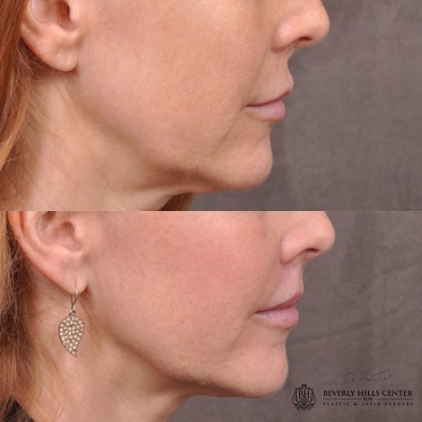 Modified upper lip lift - Right