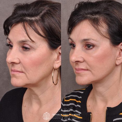 AuraLyft, browlift, Ptosis repair, Upper and lower blepharoplasty with fat repositioning, SMAS Graft lip augmentation, perioral CO2 laser - Left Side