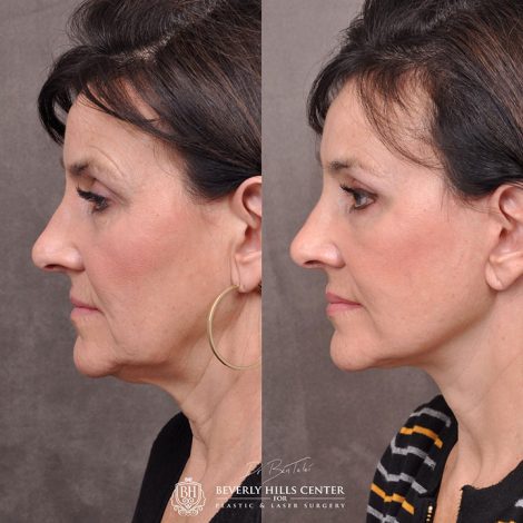 AuraLyft, browlift, Ptosis repair, Upper and lower blepharoplasty with fat repositioning, SMAS Graft lip augmentation, perioral CO2 laser - Left Side