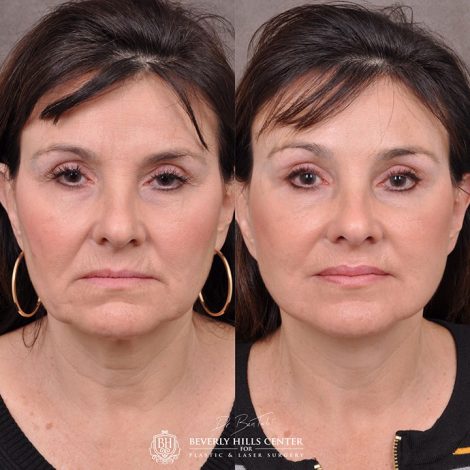AuraLyft, browlift, Ptosis repair, Upper and lower blepharoplasty with fat repositioning, SMAS Graft lip augmentation, perioral CO2 laser - Front