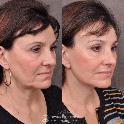 AuraLyft, browlift, Ptosis repair, Upper and lower blepharoplasty with fat repositioning, SMAS Graft lip augmentation, perioral CO2 laser - Right Side