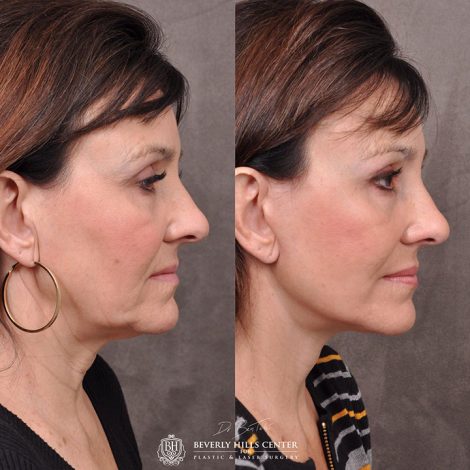 AuraLyft, browlift, Ptosis repair, Upper and lower blepharoplasty with fat repositioning, SMAS Graft lip augmentation, perioral CO2 laser - Right Side