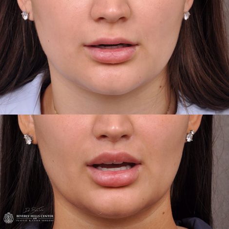 Modified Upper Lip Lift - Front