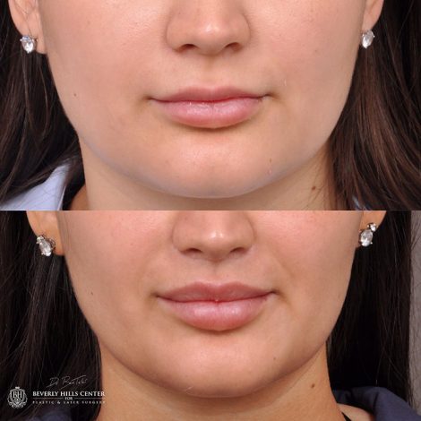 Modified Upper Lip Lift - Front