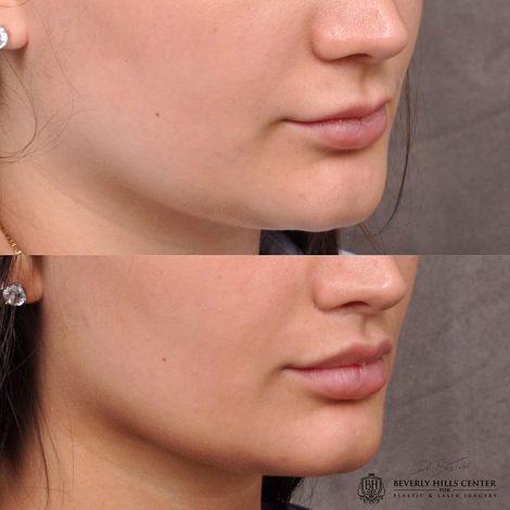 Modified Upper Lip Lift - Right Side