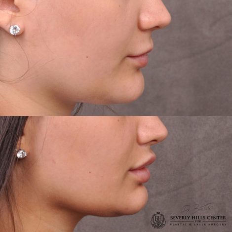 Modified Upper Lip Lift - Right Side