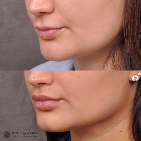 Modified Upper Lip Lift - Left Side
