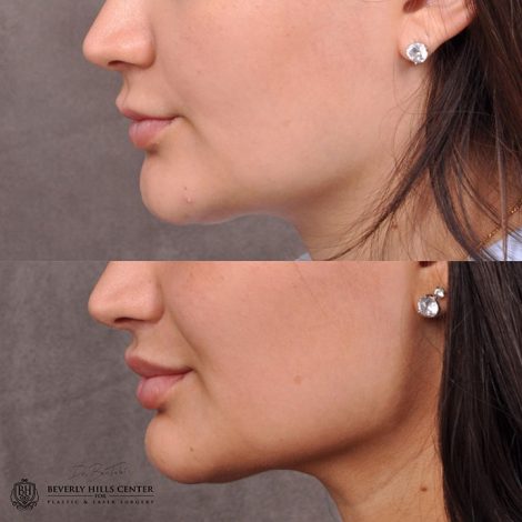 Modified Upper Lip Lift - Left Side