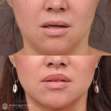Modified upper lip lift - Front