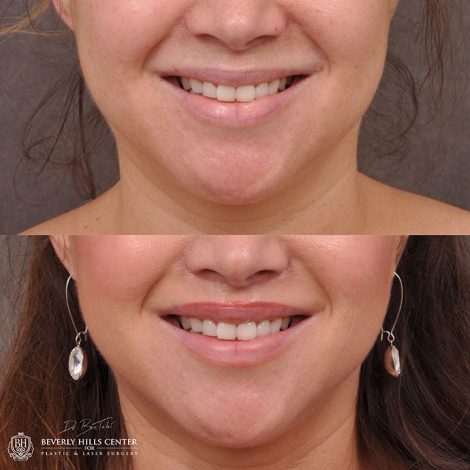 Modified upper lip lift - Front