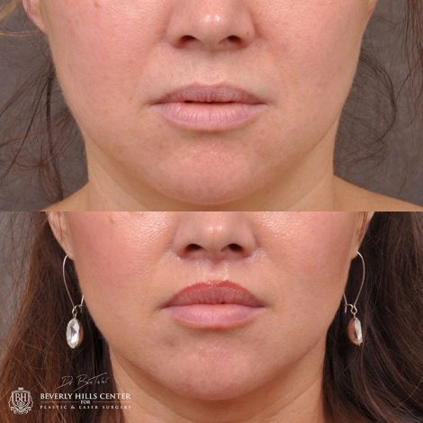 Modified upper lip lift - Front