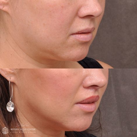 Modified upper lip lift - Right