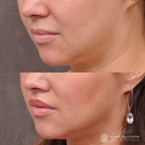 Modified upper lip lift - Left