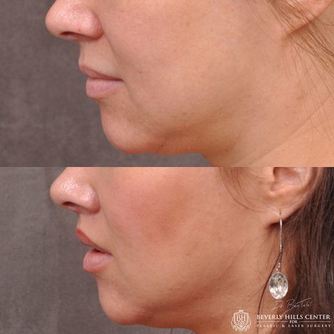 Modified upper lip lift - Left